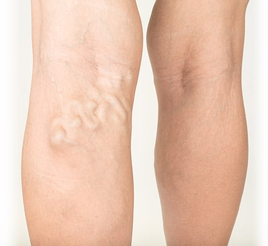 Symptoms of common varicose veins