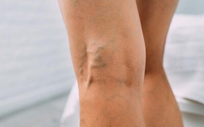 Vein treatments give mothers top results
