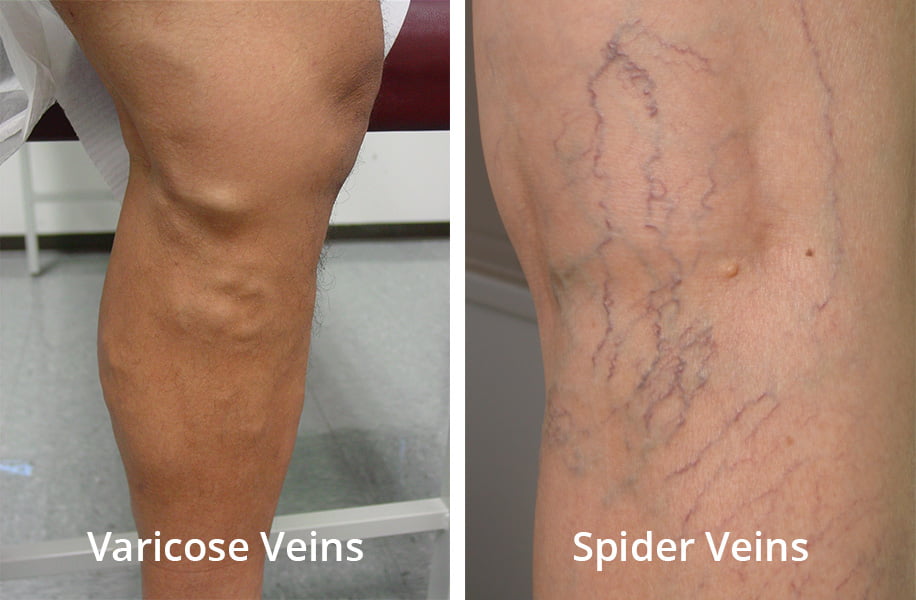 spiderveinVSvaricosevein