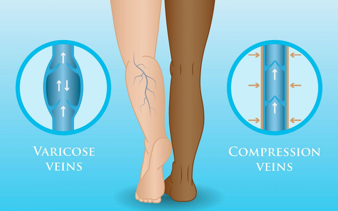 How Compression Socks work with veins