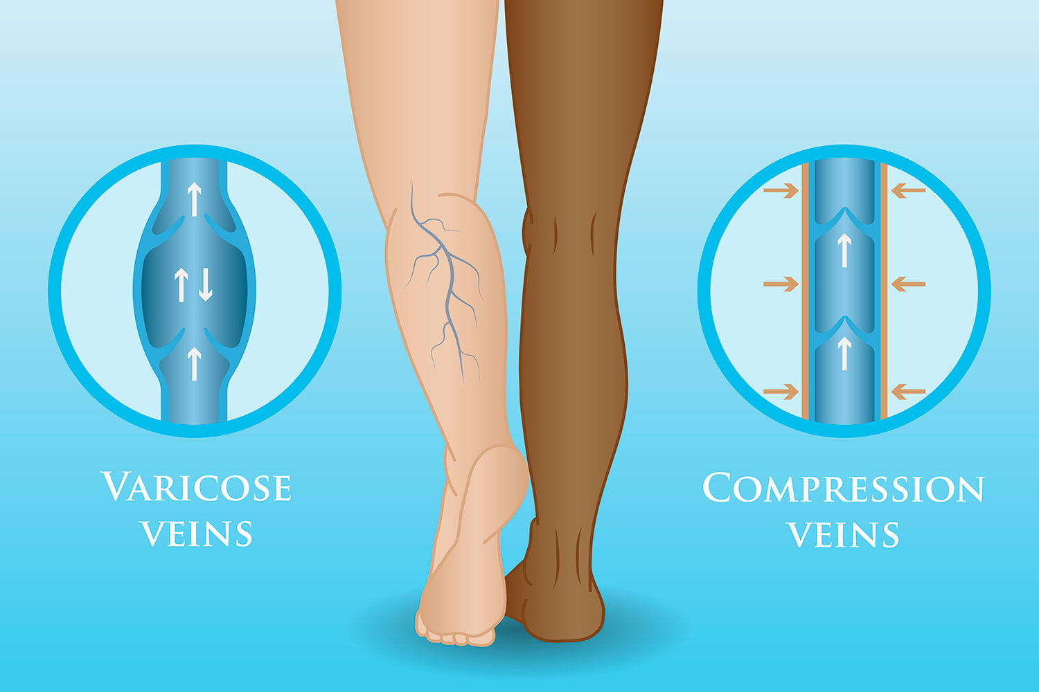 How Wearing Compression Stockings Can Help Your Varicose