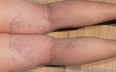 All About Spider Veins: What are they? Causes? Common questions.