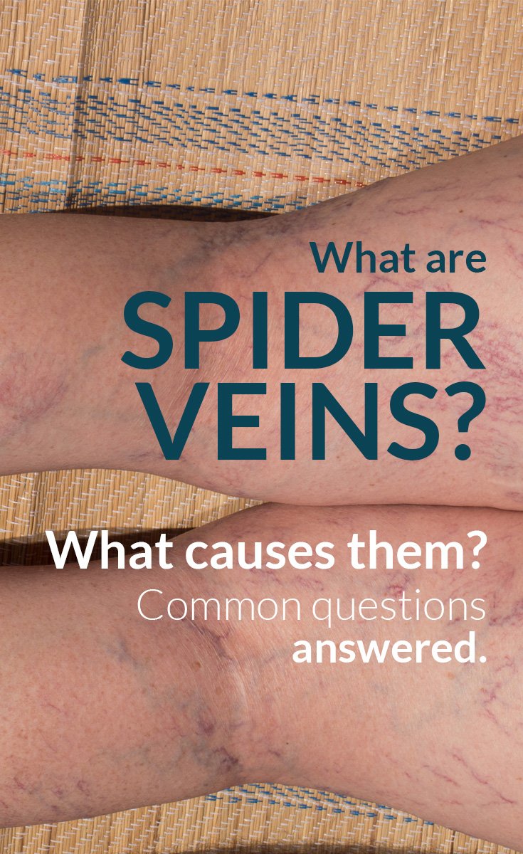 blog-spiderveins-pin