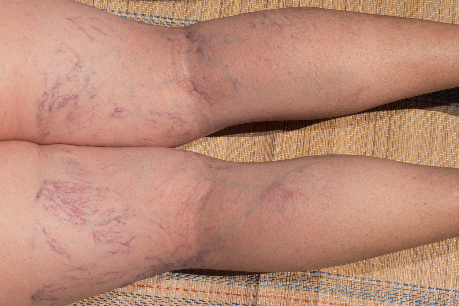Spider Veins: What are they? Common questions.