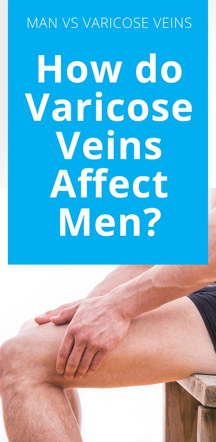 Man Vs Varicose Veins: How do Varicose Veins Affect Men?