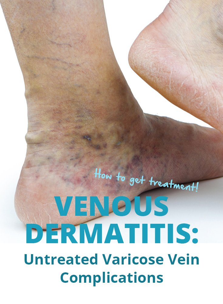 blog-venous-dermatitis-pin
