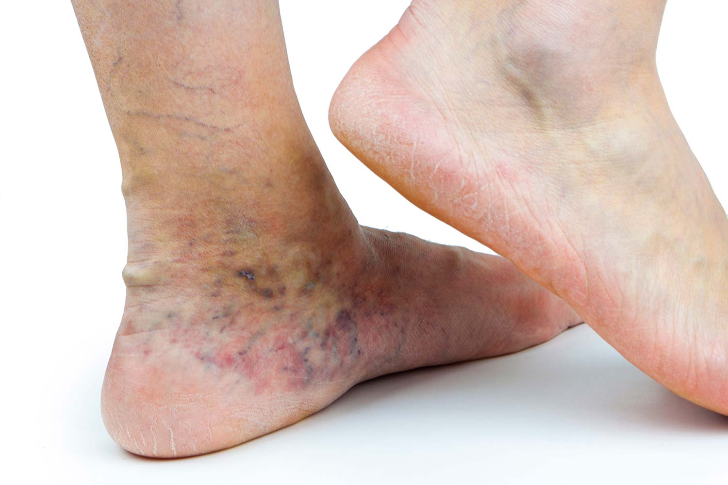 Varicose Veins in Feet and Ankles, Symptoms and Treatment