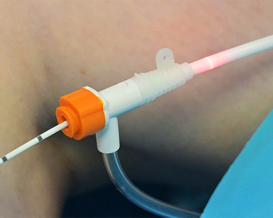 endovenous-laser-ablation-1