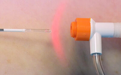 Endovenous Laser Ablation (EVLA)