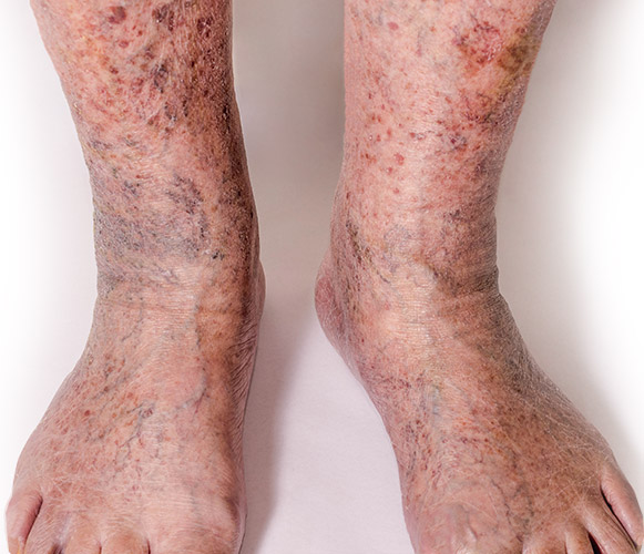 Severe Varicose Veins - Symptoms of severe venous insufficiency