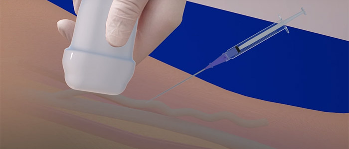 Medical Adhesives (Glue) Closure - Varicose Vein Treatment