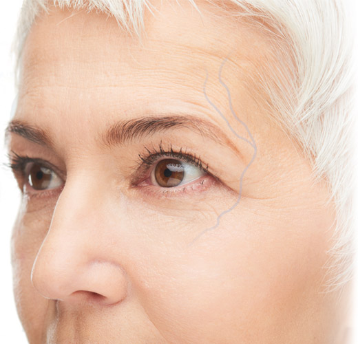 Periorbital veins - large blue vein around eye socket