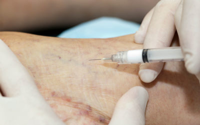 Sclerotherapy: What is Sclerosant and Why Does it Work On Varicose Veins?