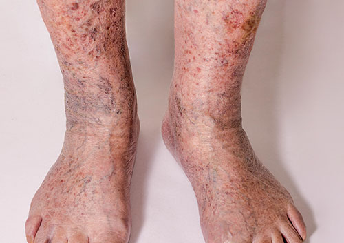 Foot displaying chronic venous disease from severe varicose veins