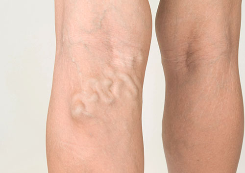 Leg with Varicose Veins