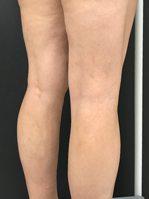 Vein Treatment Case Study - 40-year-old with Varicose Veins