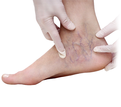 Vein Specialist in Clifton, NJ