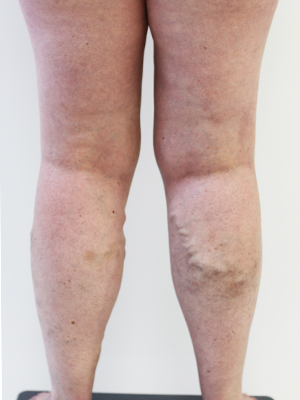 Case Study: 42-year-old Woman with Large Varicose Veins