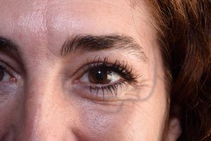 All eyes are on a non-surgical treatment that targets periorbital veins