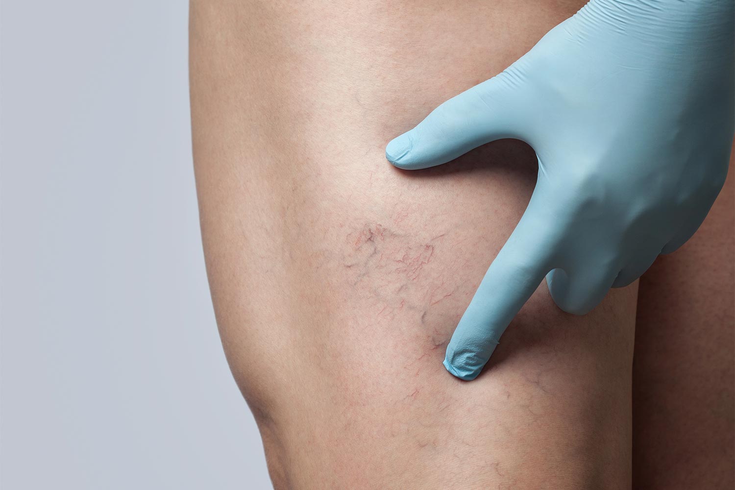 The Difference Between Varicose And Spider Veins - The Vein Institute