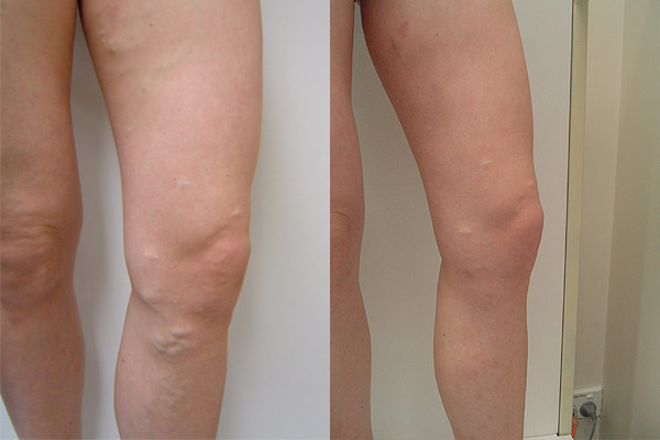 Before and After - Varicose Veins