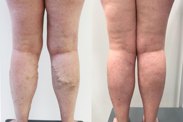 Varicose Veins Treatment Before and Afters | Vein Health