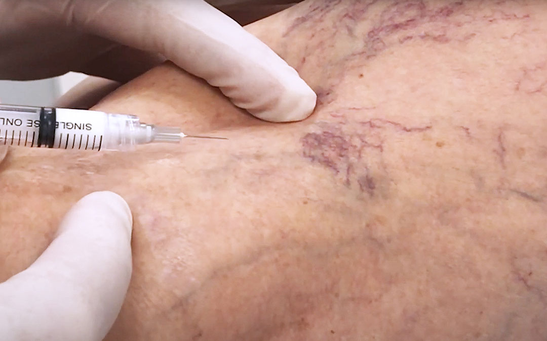 Sclerotherapy syringe about to inject back of leg covered in varicose veins and spider veins