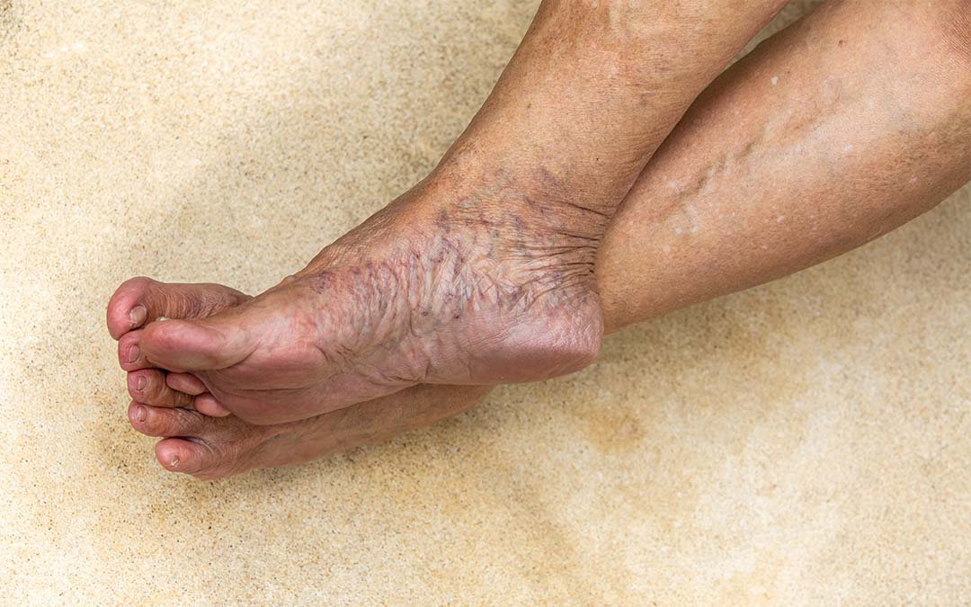 Bare feet crossed at ankles, with extensive varicose veins on feet and ankles
