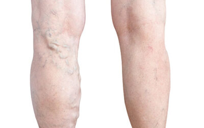 Varicose Vein Recurrence