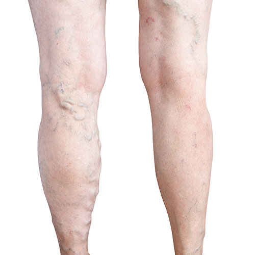 Venaseal Vein Glue Varicose Veins Treatment Vein Health