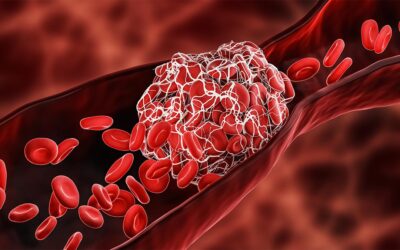 Diagram of a blood clot in a vein