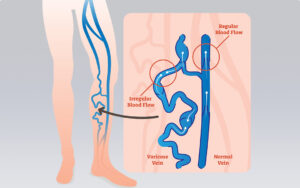 Diagram showing backflow of blood in leg veins, and cross section of what's happening inside the veins.