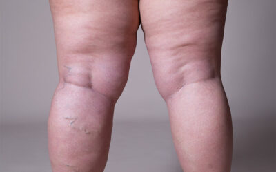 Is there a connection between lipoedema and varicose veins?