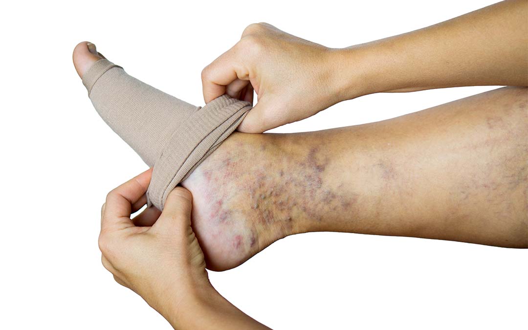 How to prevent varicose veins | Vein Health