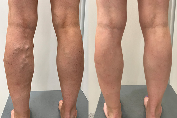 Varicose Veins Treatment Before and Afters | Vein Health