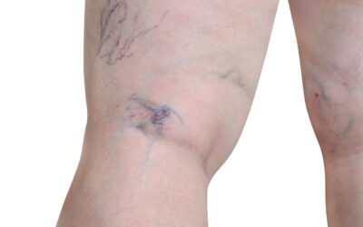 Varicose Veins Behind the Knee