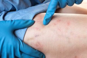 A gloved hand points to red, blotchy skin with visible irritation and small veins on a person's leg, illustrating how veins can recur even after treatment.