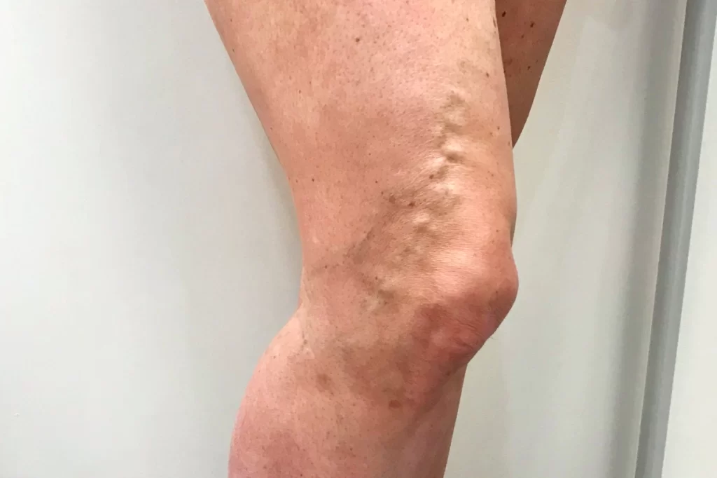Close-up of a human leg showing visible, protruding varicose veins above the knee as discussed in our beginner’s guide to vein health.
