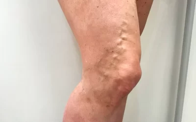 One Patient’s Journey with Recurring Varicose Veins