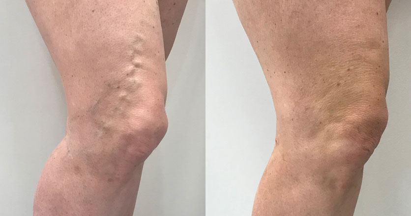 Before and after of varicose vein treatment