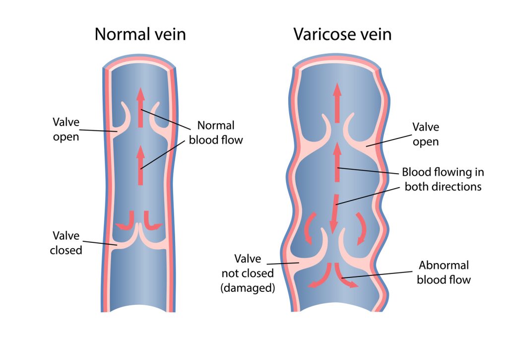 Diagram comparing a normal vein with unidirectional blood flow to a varicose vein showing venous reflux with damaged valves and abnormal, bidirectional flow.