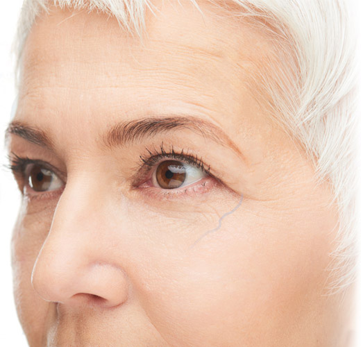 An older woman with white hair and blue under-eye veins