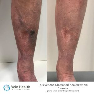 A man's legs showing severe venous ulcer, before and after treatment.