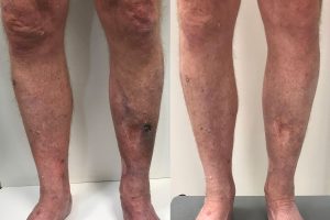 A man's legs showing severe venous ulcer, before and after treatment.