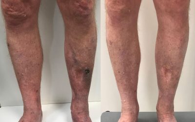 Patient Case Study: A Closer Look at Venous Ulcers