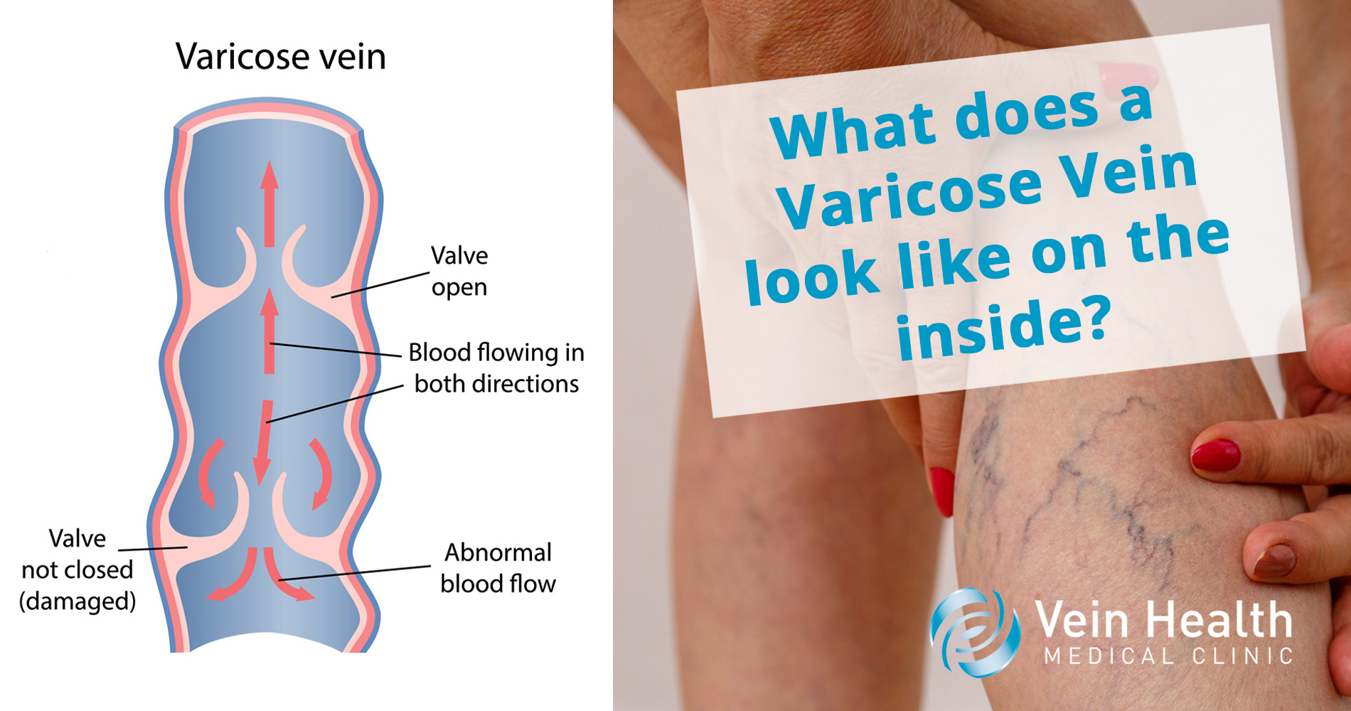 Diagram of bloodflow in a varicose vein