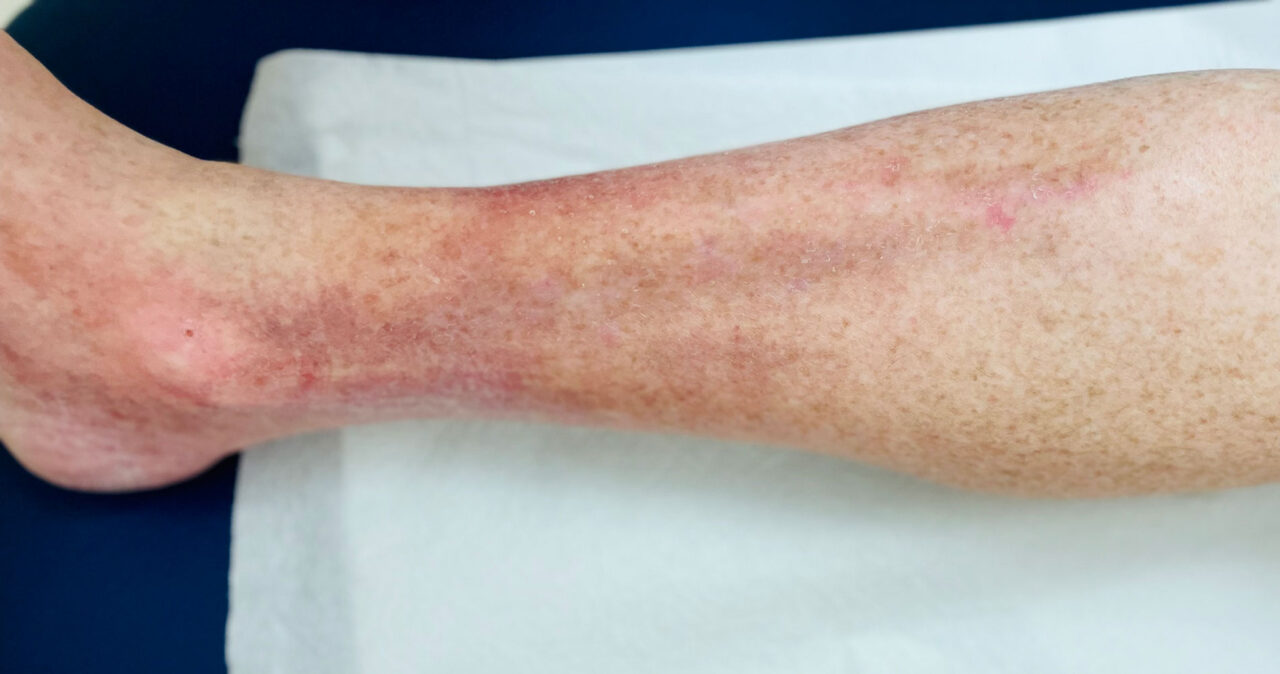 Understanding Itchy Veins: Venous Eczema Facts & Treatment Options