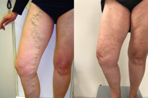 Side-by-side comparison of legs showing varicose veins on the left and smooth skin on the right after treatment.