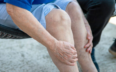 5 Complications Every Varicose Vein Sufferer Needs to Know