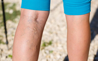 Why Do Varicose Veins Appear In One Leg Only?